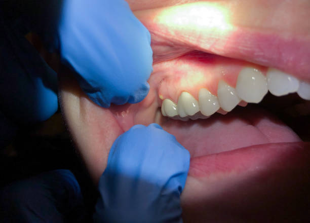 Best Knocked-Out Tooth (Avulsed Tooth) Treatment in Bromley, KY